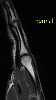 Figure 2 for case A2 pulley rupture finger (RID2437)